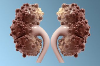 RIÑONES POLIQUÍSTICOS- Causas, síntomas y tratamiento