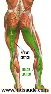 Dolor ciático