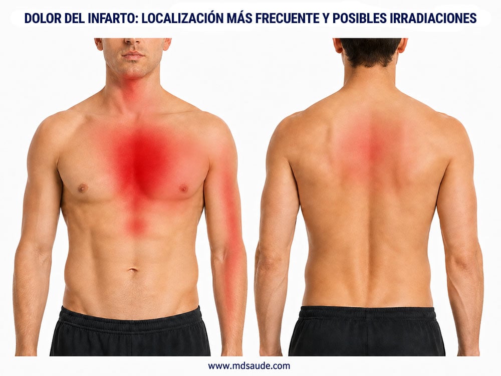 La región central del pecho es la localización más frecuente del dolor del infarto. Las molestias pueden irradiarse hacia uno o ambos brazos, los hombros, el cuello, la mandíbula, la espalda o la parte superior del abdomen. No es necesario que todas estas zonas estén afectadas simultáneamente.