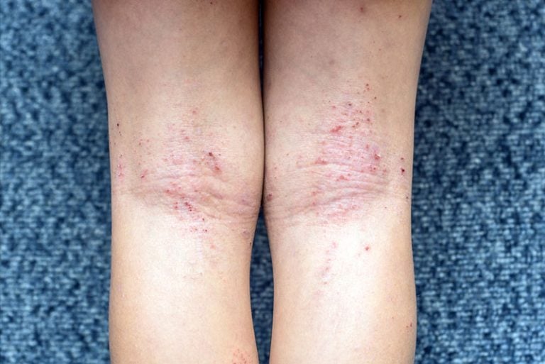 6 tipos de eczema causas, sintomas e tratamento MD.Saúde