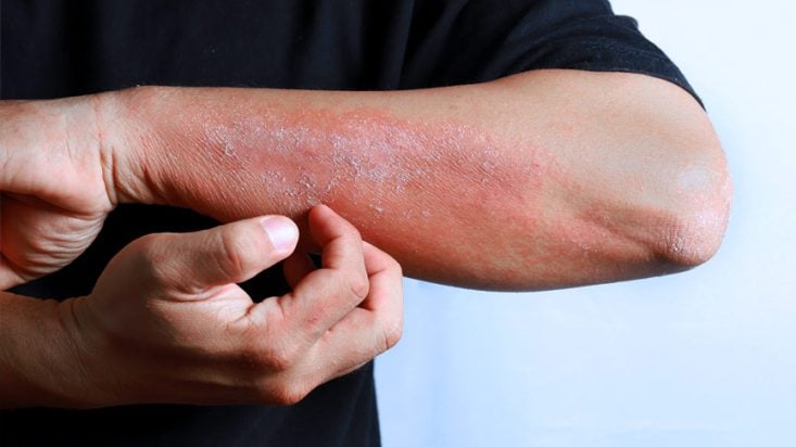 6 tipos de eczema (eccema): qué es, síntomas y tratamiento