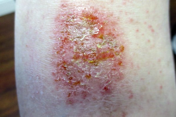 Eczema numular - foto 1