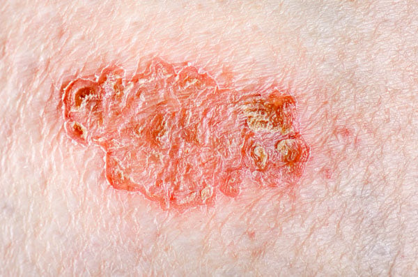 Eczema numular - foto 3