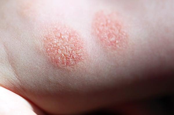 Eczema numular - foto 4