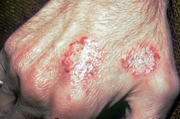 Eczema numular - foto 6