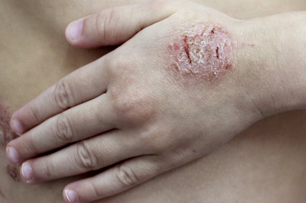 Eczema numular - foto 5
