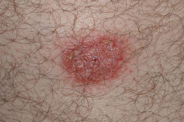 Eczema numular - foto 2