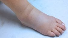 Edema nos pés