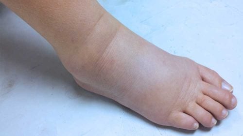 Edema nos pés