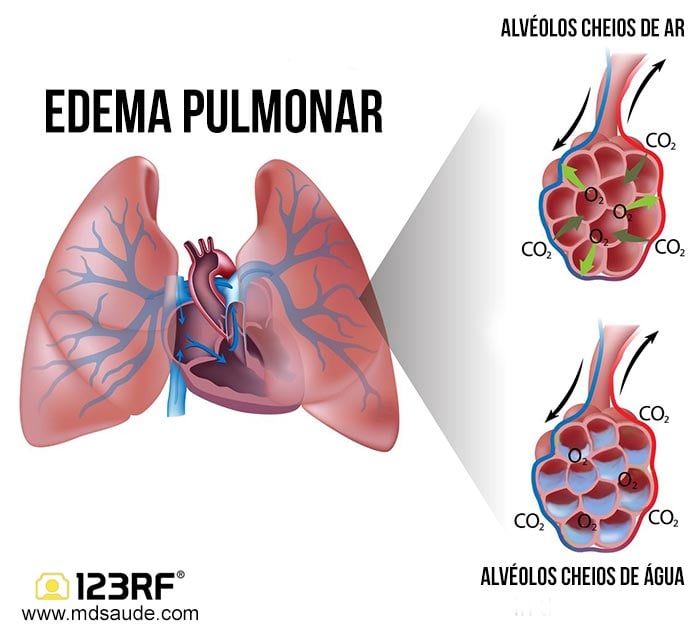 Edema pulmonar: sintomas, causas e tratamento | MD.Saúde