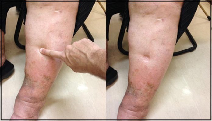 edemas-imagem Edema com cacifo
