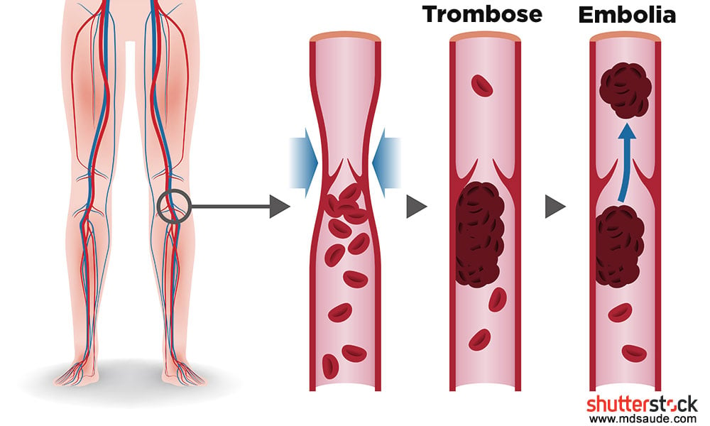 Embolia