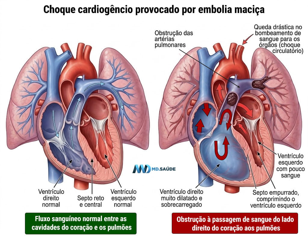 Ilustração comparando um coração normal com outro afetado por embolia pulmonar grave, mostrando obstrução das artérias pulmonares por trombos, dilatação do ventrículo direito, deslocamento do septo interventricular e compressão do ventrículo esquerdo.