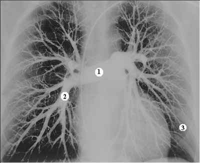 Angiografía pulmonar