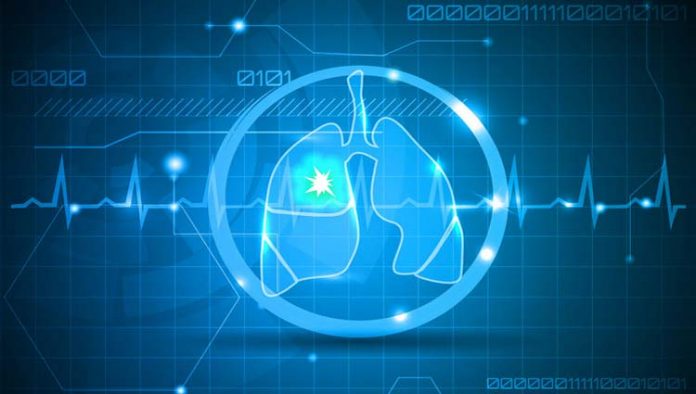 embolia-pulmonar Embolia pulmonar