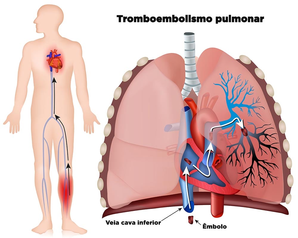 Tromboembolismo pulmonar