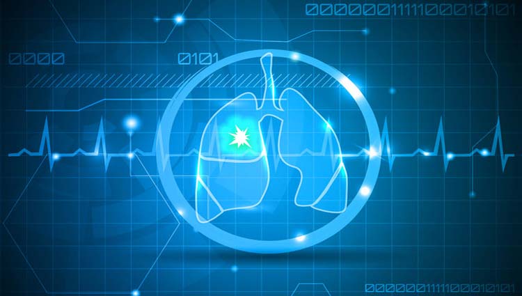 Embolia pulmonar