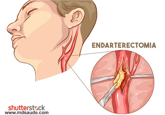 Como é feita a endarterectomia da carótida.