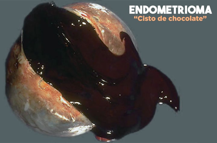 Endometrioma: cisto de chocolate.
