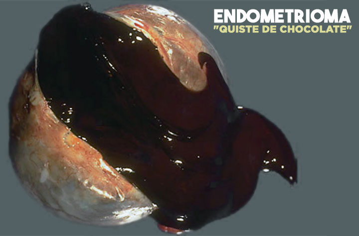 Endometrioma