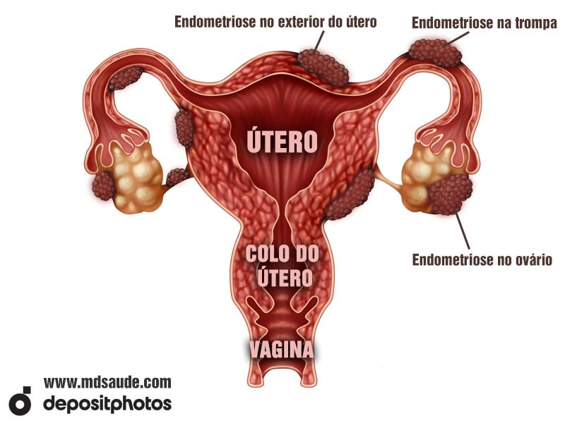 Locais comuns da endometriose