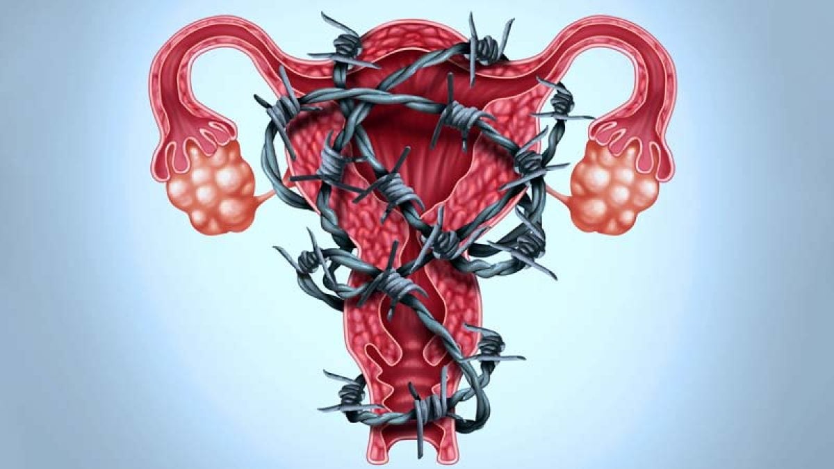 Foto de Sintoma De Endometriose Sangue Menstrual Com Coágulos De