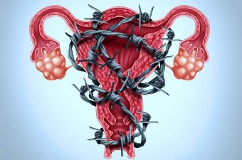 ENDOMETRIOSIS – Síntomas, causas y tratamiento