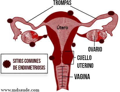 Sitios comunes de endometriosis
