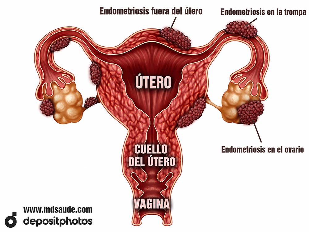 Localizaciones más frecuentes de la endometriosis
