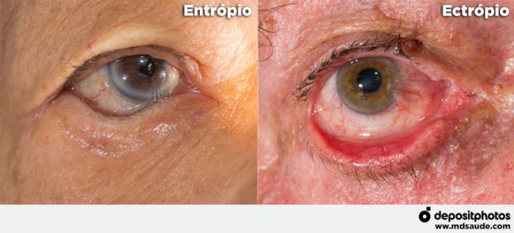 Lacrimejamento excessivo (epífora): causas e tratamento