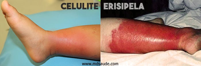 Diferença entre erisipela e celulite