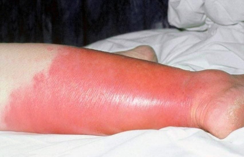 Erisipela y celulitis - Síntomas, causas y tratamiento -
