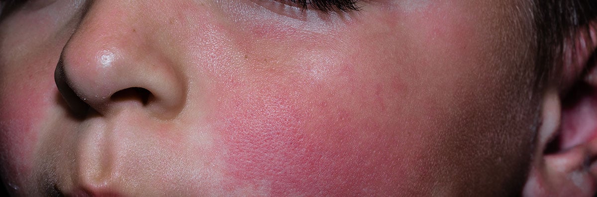 Rash na face do eritema infeccioso