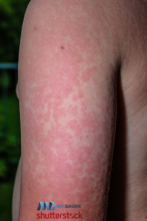 Rash do eritema infeccioso no braço