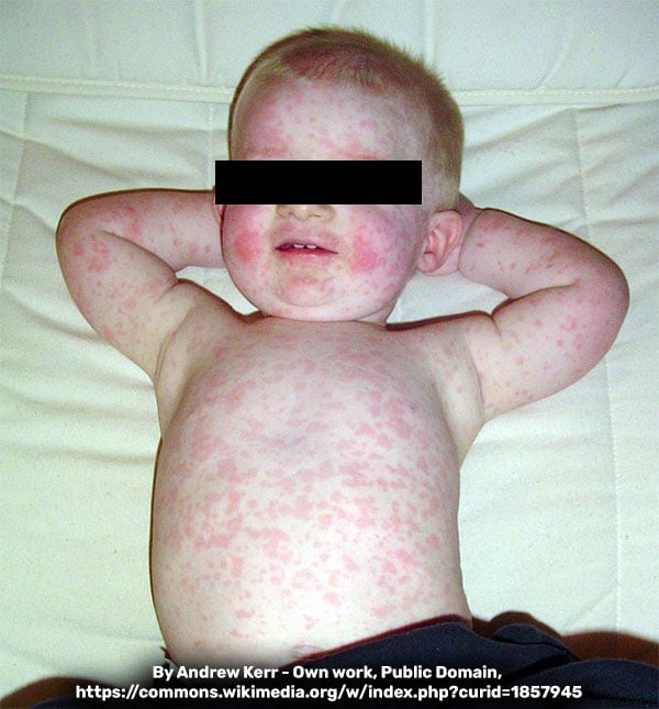 Rash do eritema infeccioso em corpo e face