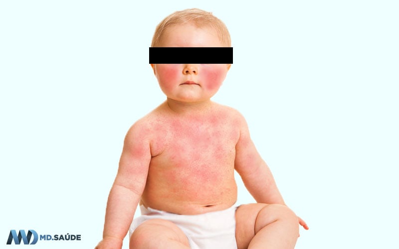Rash do eritema infeccioso no corpo de um bebê