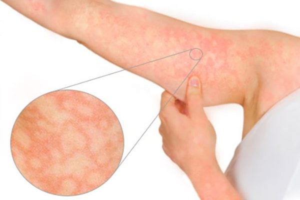 Rash do eritema infeccioso