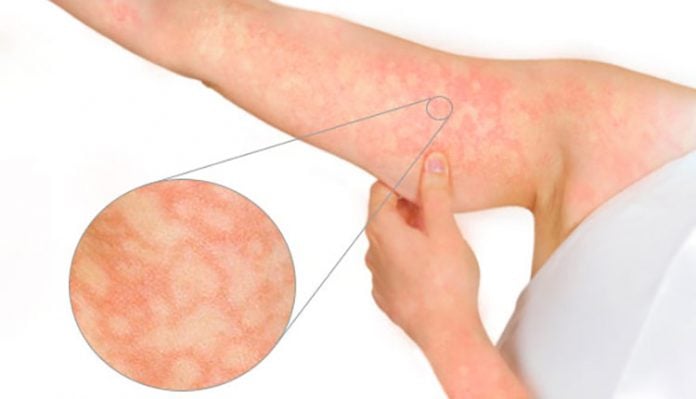 eritema-infeccioso-parvovirus-imagem Rash do eritema infeccioso