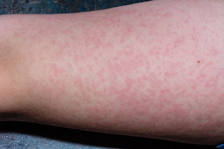 Eritema infeccioso