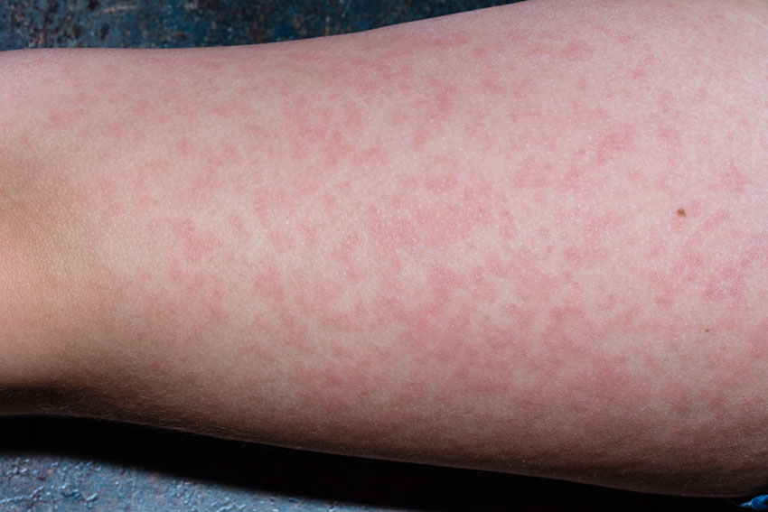 Eritema Infeccioso Sintomas Transmiss o E Tratamento Eritema Infeccioso Sintomas Transmiss o E Tratamento