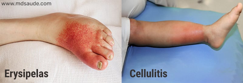 Differences between erysipelas and cellulitis