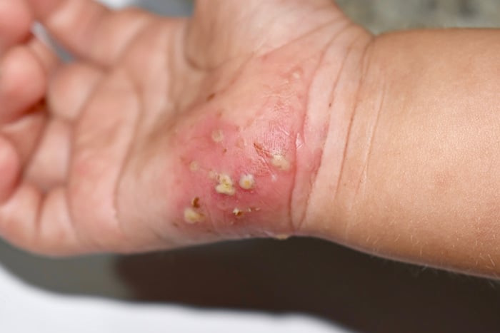Lesión infectada de sarna con infección bacteriana secundaria