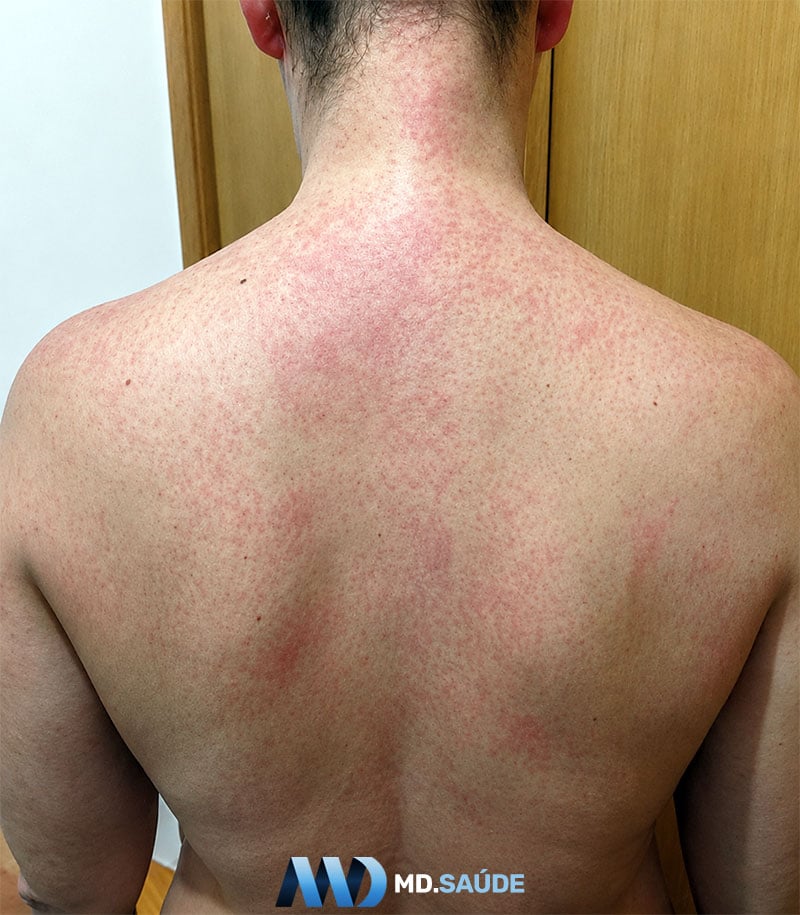 Rash cutâneo da escarlatina no tronco.