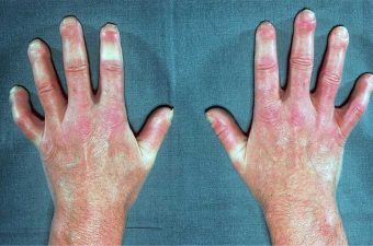 ESCLERODERMIA – Causas, síntomas y tratamiento