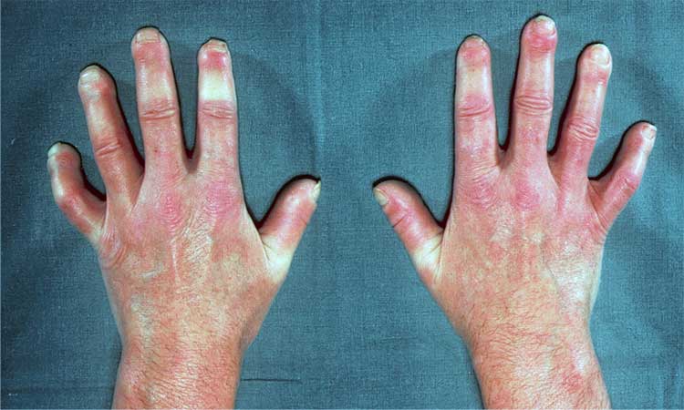 Mãos da esclerodermia