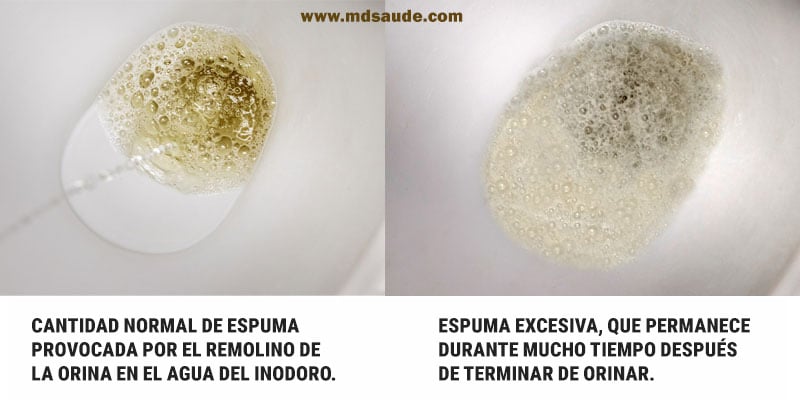 Espuma en la orina
