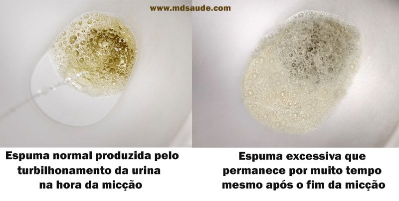 Comparação entre urina normal e urina espumosa