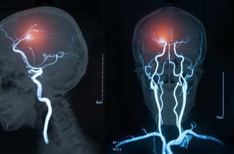 Estenose da artéria carótida