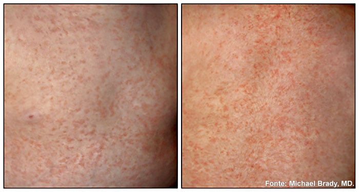 Roseola Exantema Subito Sintomas E Tratamento Md Saude