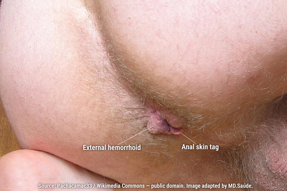 External hemorrhoid with no signs of inflammation or thrombosis. Adjacent anal skin tag.